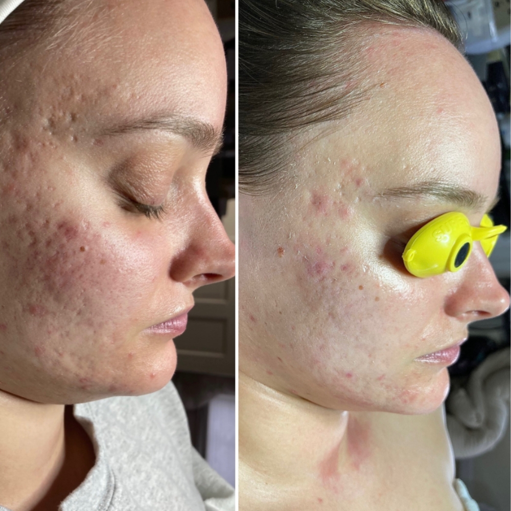 Acne Scars before and after innopen microneedling
