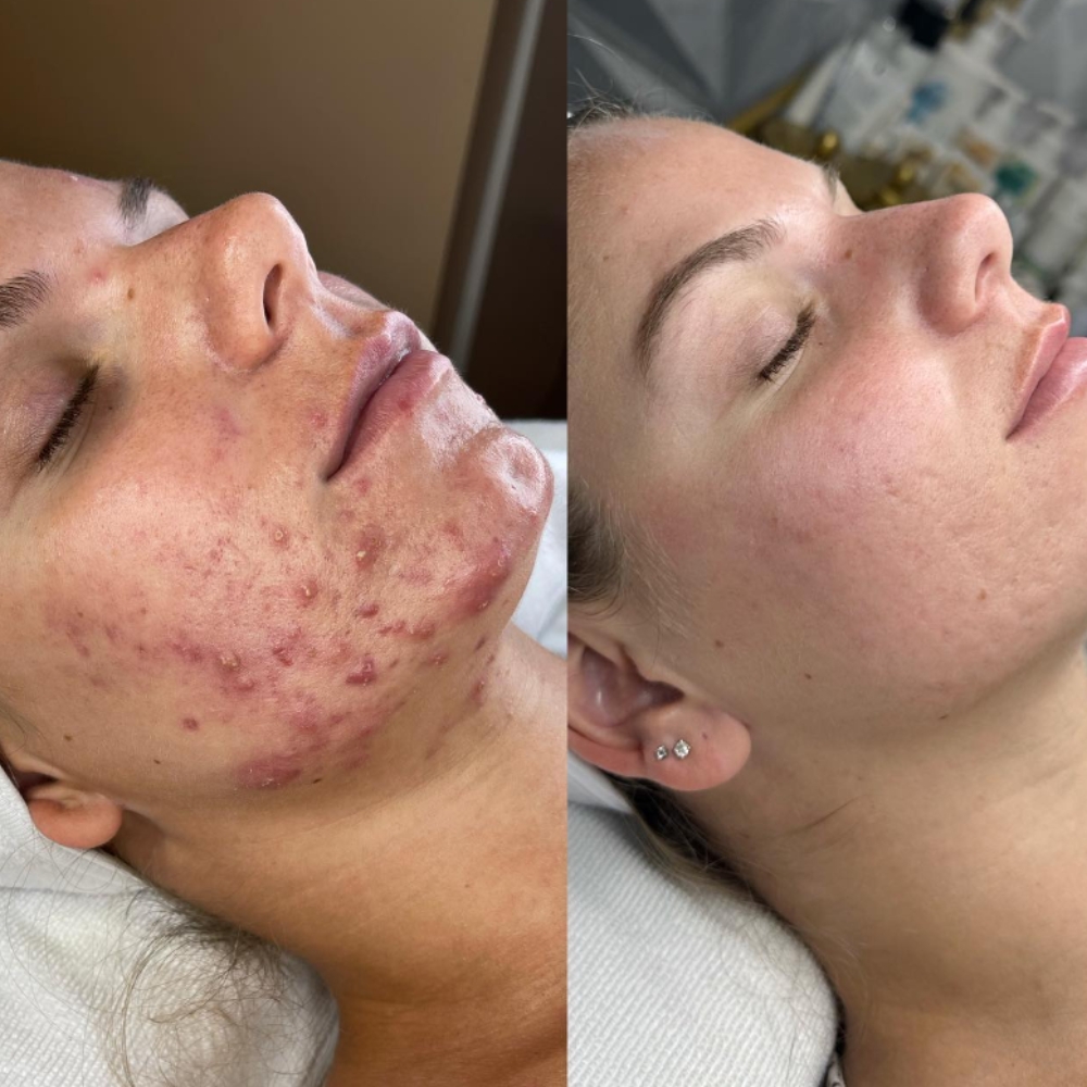 acne scar microneedling trnasformation with innopen