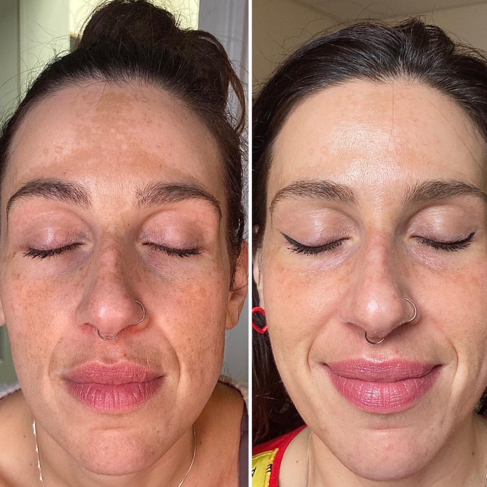 melasma before and after with microneedling