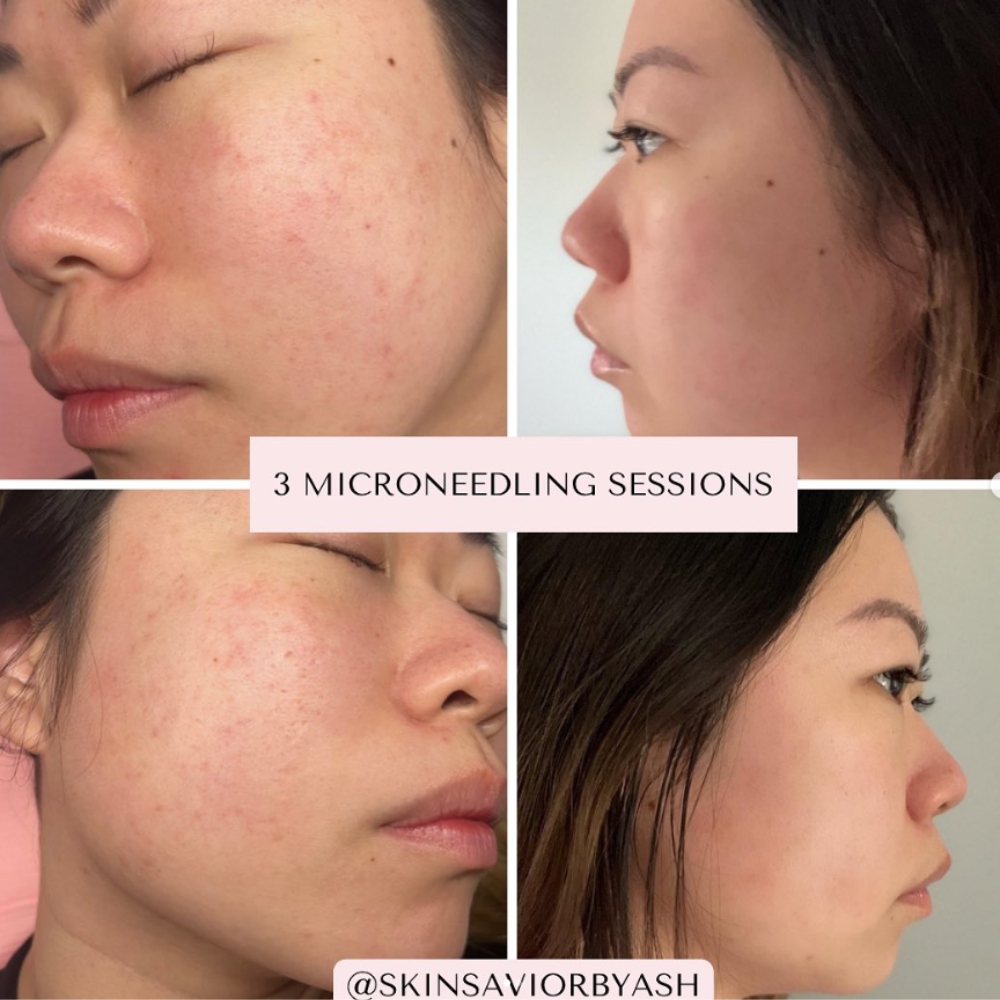 Uneven skin before and after with microneedling