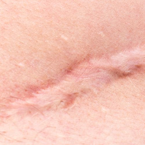 Hypertrophic Scars