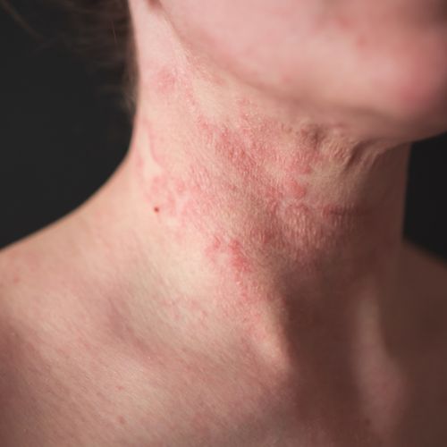 Contact dermatitis