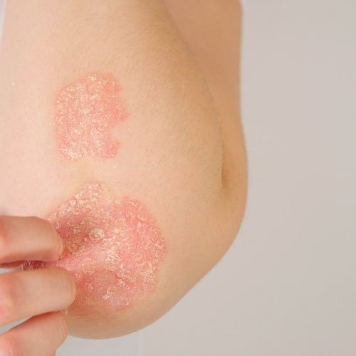 Eczema