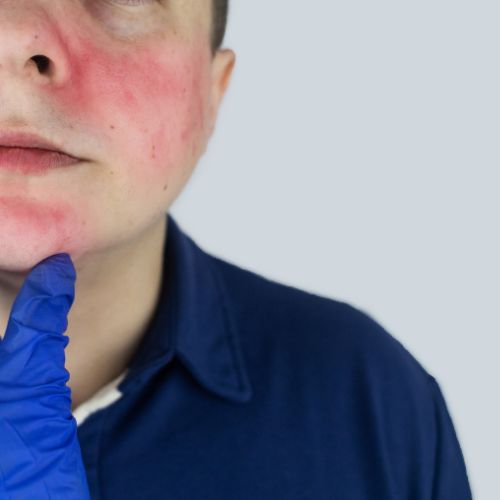 Rosacea