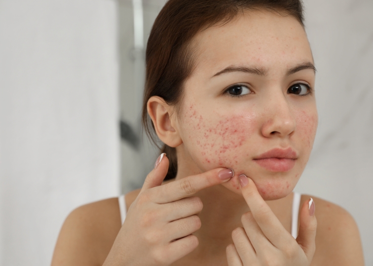 Acne Scars: A Guide for Estheticians