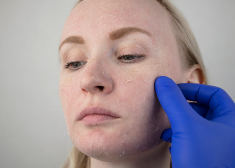 What does dry skin look like under a Dermatoscope?