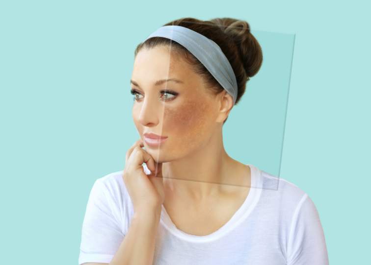 Hyperpigmentation vs. Melasma: Key Differences and Effective Treatments