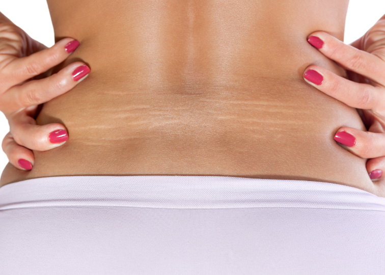 Does Microneedling Repair Stretch Marks?
