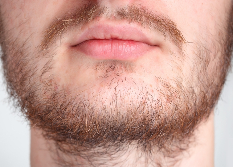 Beard Growth Potential with The MTS Rollers: A Guide