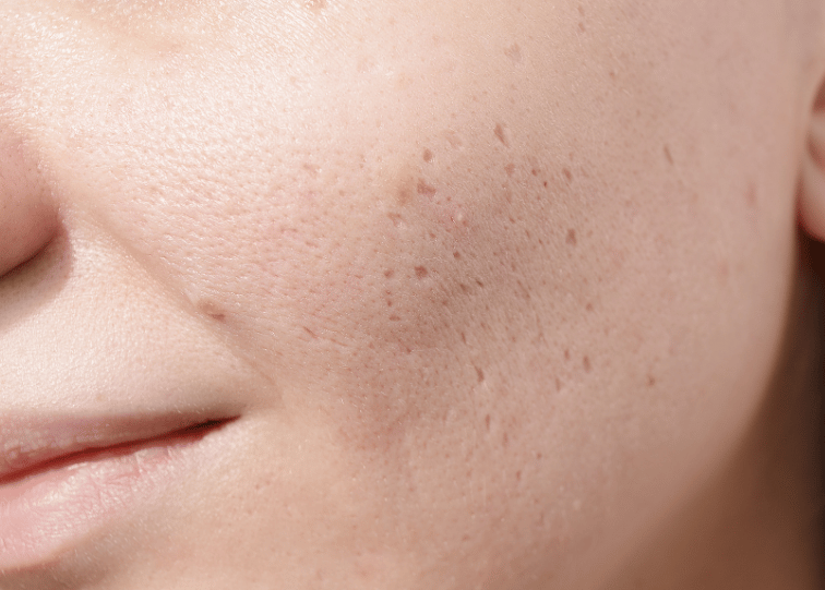Microneedling for Various Skin Concerns
