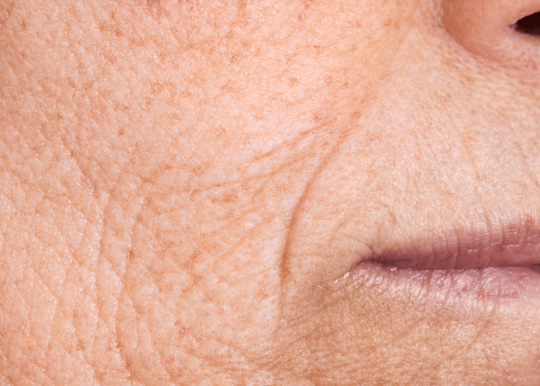 wrinkles