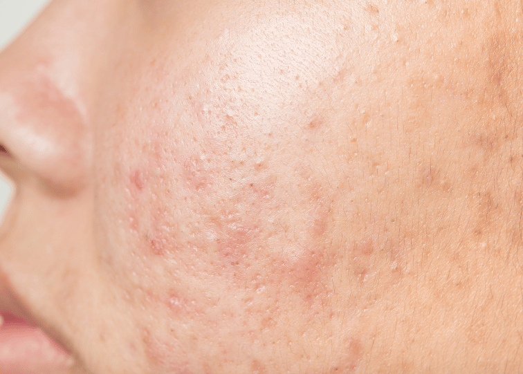 acne scars