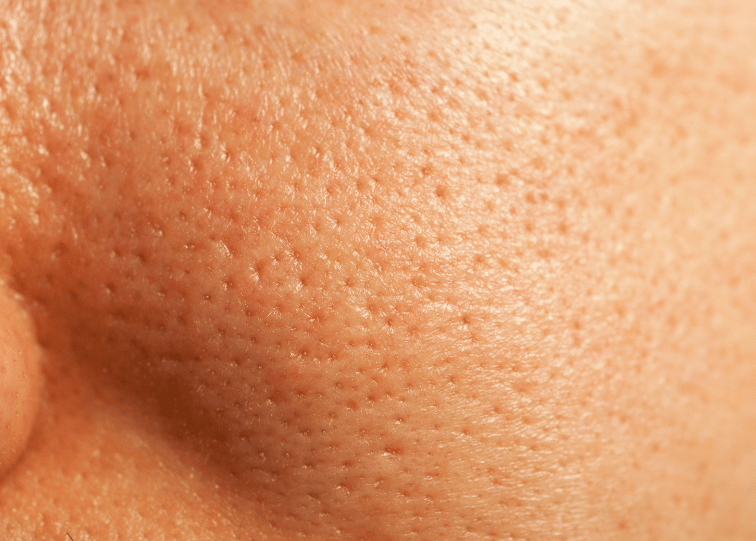 Enlarged pores