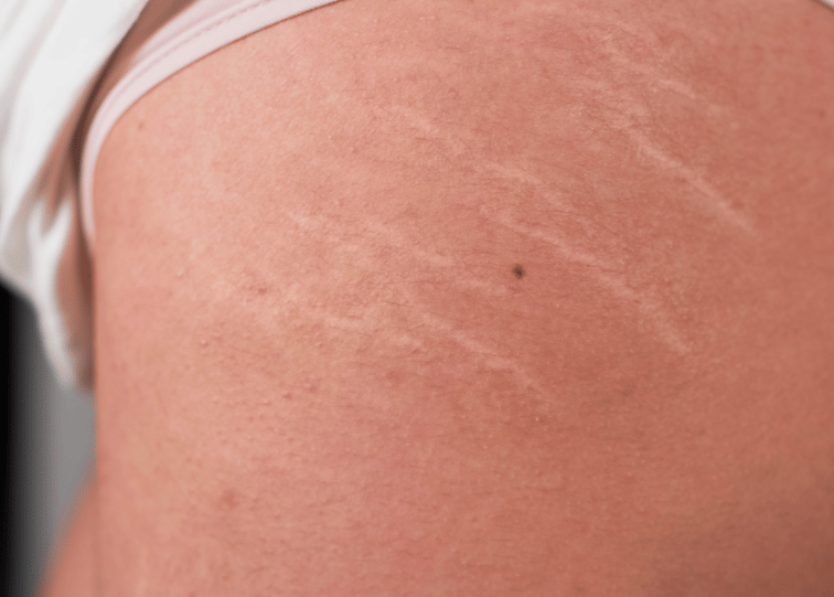 stretch marks
