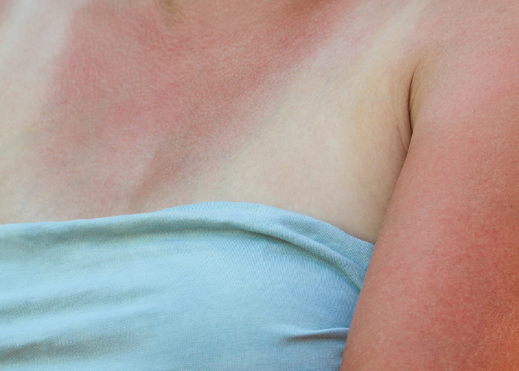 sun damage