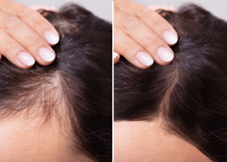 hair loss