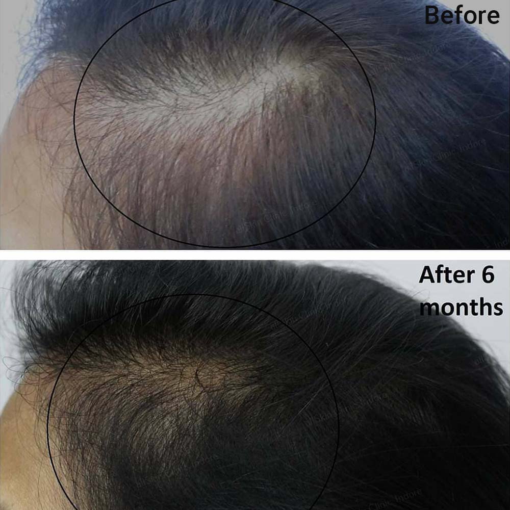 Derma Roller Hair Regrowth - All You Need to Know